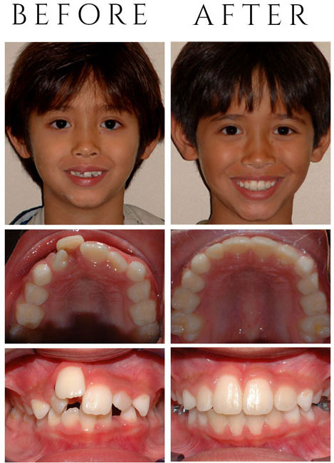 Narrow Upper and Lower Jaws – Phase One (Early Treatment at 8 yrs old) using Jaw Expanders was required.