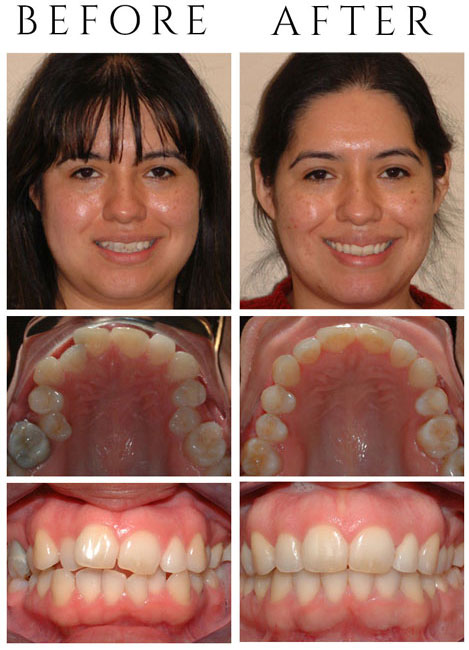 Crowding, Midline Discrepancy, & Missing Teeth – The Patient had an Asymmetric Extraction Pattern to Alleviate the Crowding and Correct her Midlines.