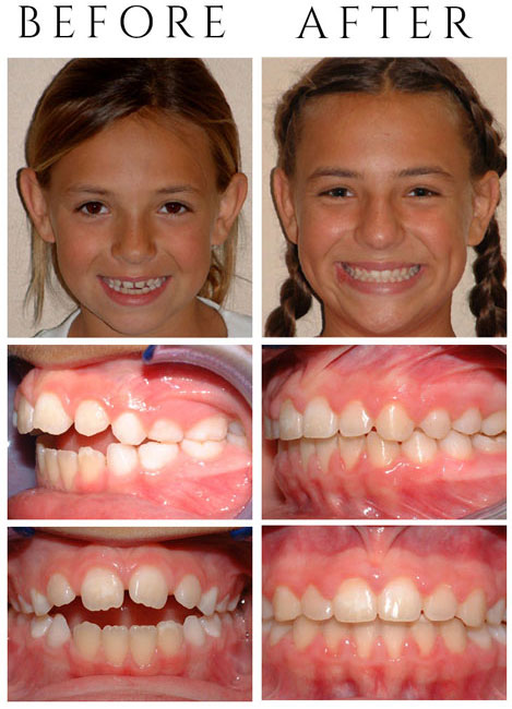 Openbite (Front Teeth Don't Touch) – The Patient had Phase One & Phase Two Treatment