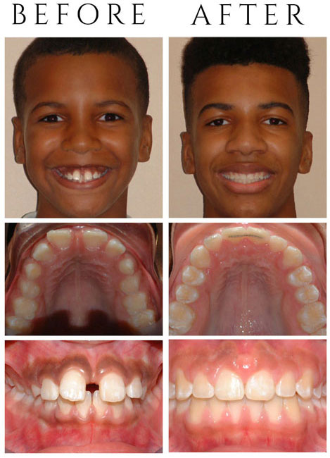 Spacing – The Patient had Phase One & Phase Two Treatment