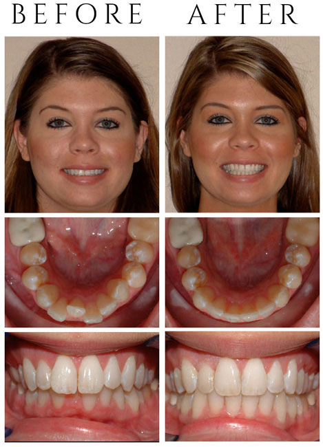 Crowding – Invisalign was done.