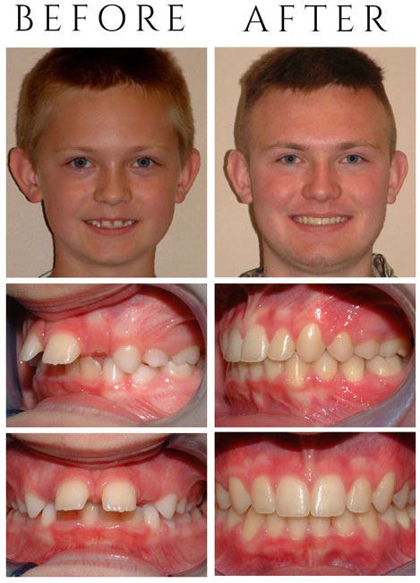 Overjet (Protruding Front Teeth) – The Patient had Phase One & Phase Two Treatment