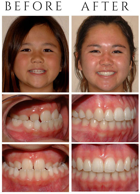 Underbite (Lower Front Teeth in Front of Upper Teeth) – The Patient had Phase One & Phase Two Treatment