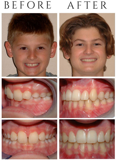 Deepbite (Lower Front Teeth Bite into Palate) – The Patient had Phase One & Phase Two Treatment